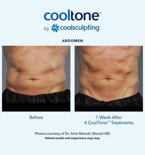 cooltone-men-absbeforeandafter before and after photo